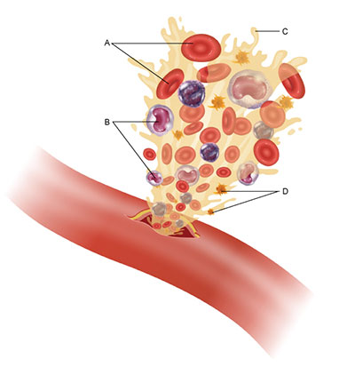 This figure shows an artery, which has a small puncture at its center. The blood is gushing out of the puncture, carrying with it the four major blood components, which are labeled A through D. Component A includes red, disk-shaped cells with a depression at their center. Component B includes white-colored cells with purple, bean-shaped nuclei. Component D includes small, yellow, star-shaped bodies. Component C is the yellowish, liquid component of the blood.